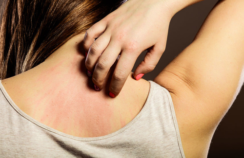 Orticaria da stress, come controllarla e risolverla Orticaria da stress, come controllarla e risolverla