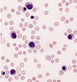 AML-M6, blood smear(Right Rotation).png